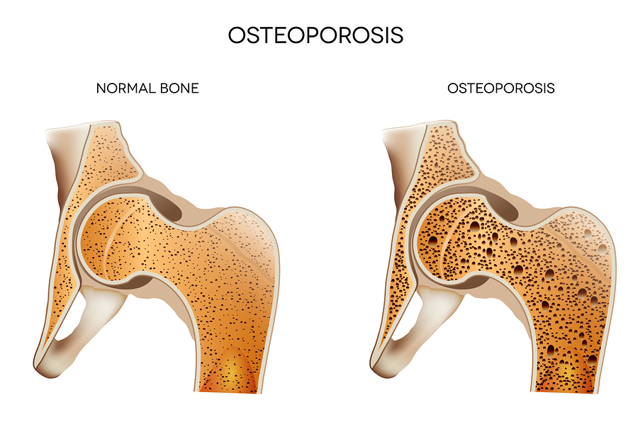 Home care assistance helps seniors manage osteoporosis and prevent falls safely